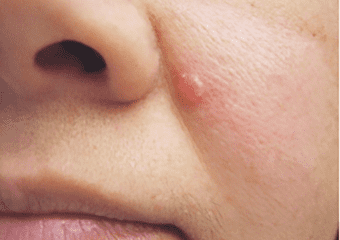 Benjolan mengilap, ciri-ciri kanker kulit di wajah