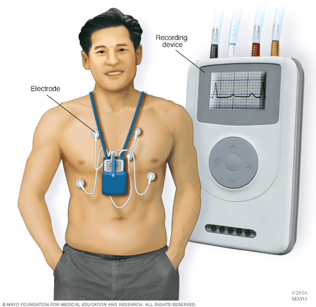 Holter Monitor: pengukuran aritmia